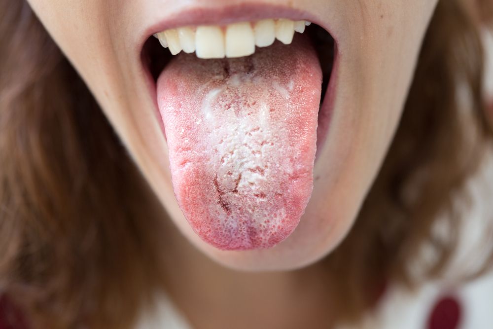 Jak se zbavit kvasinek v ústech?