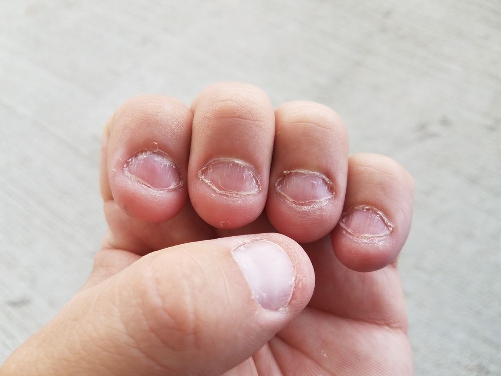 Jak se zbavit kousání nehtů?
