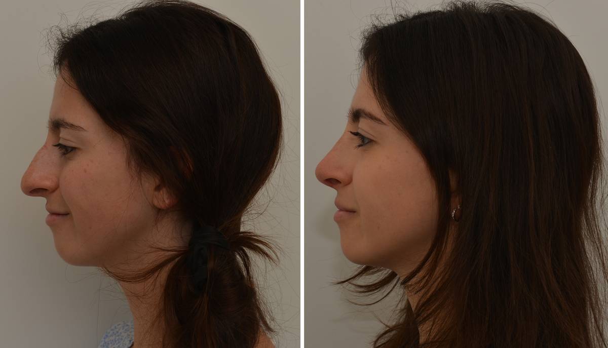 Krásný profil po rhinoplastice
